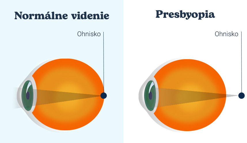image of focal point in normal eye and in eye with presbyopia
