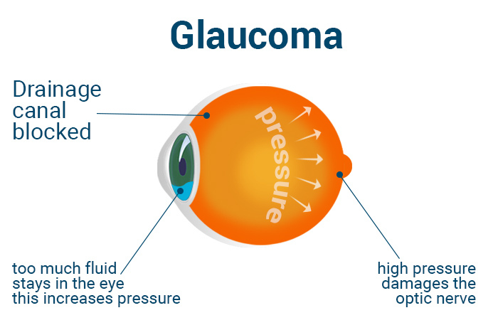 Oko s glaukómom