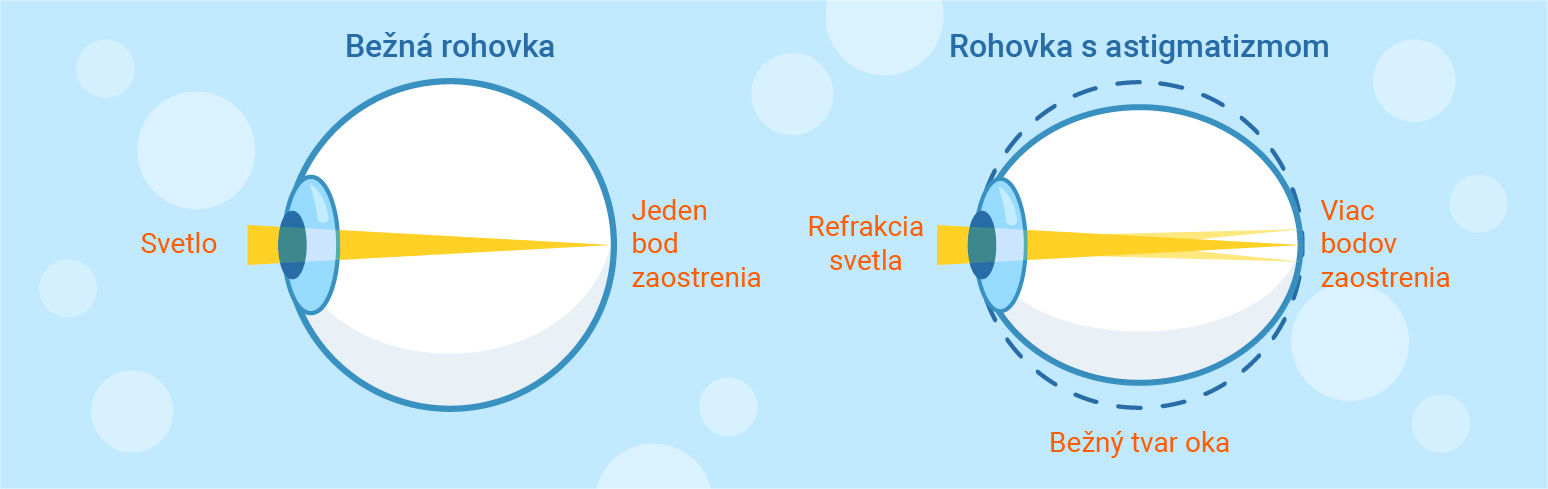 klasická a astigmatická rohovka